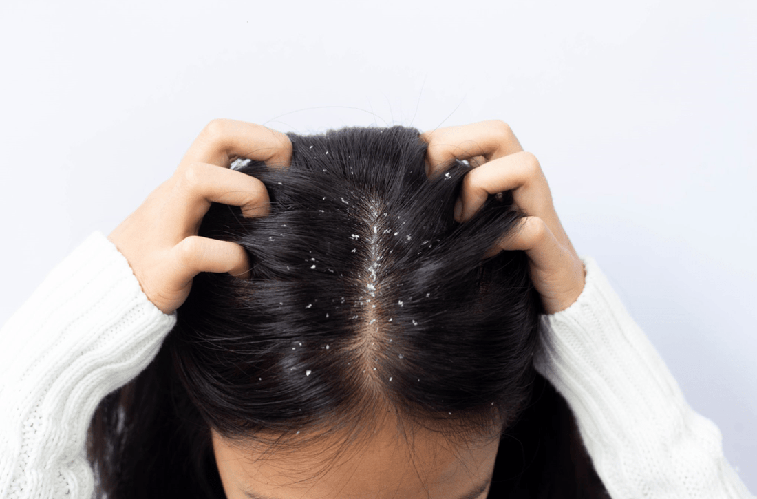 Understanding Dandruff: Causes, Treatments, and Management Tips - Katharē Hair Care