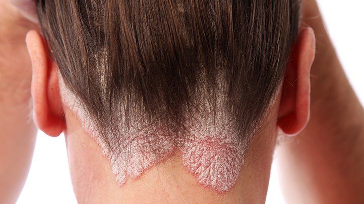 Scalp Psoriasis: Facts and how to treat it - Katharē Hair Care